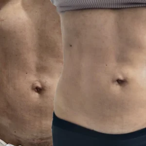 Fibrosis